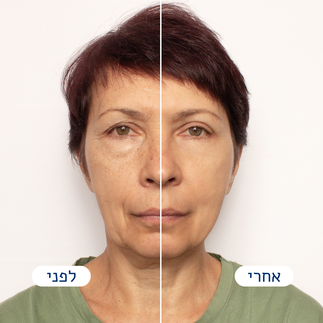 Frova™ - הפטנט לעיצוב הפנים וקו הלסת