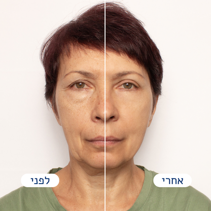 Frova™ - הפטנט לעיצוב הפנים וקו הלסת